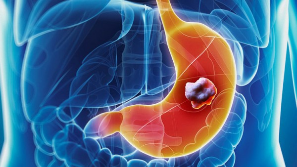 اسباب سرطان المعدة و اعراض سرطان البطن